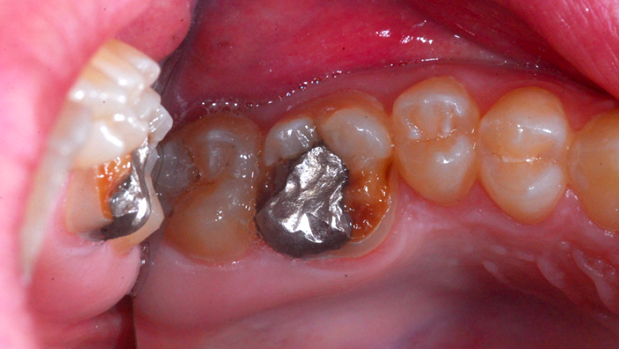 failed amalgam restoration dental work