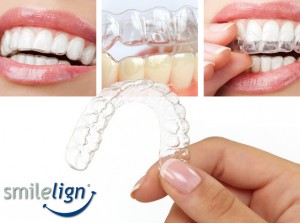 Smilelign Invisible Braces