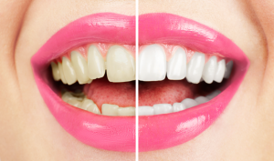 Harrogate Dentist Tooth Whitening